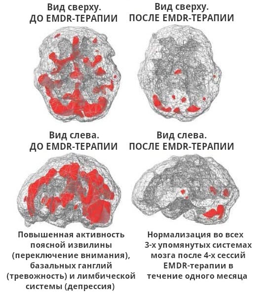 Мозг до и после ДПДГ (МРТ-сканирование)
